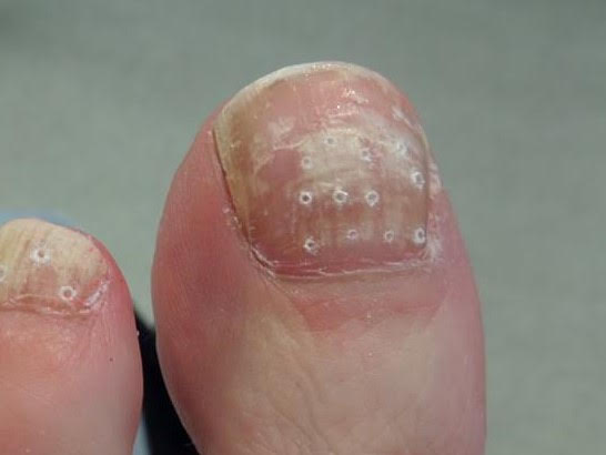 big toe with fungal nail infection